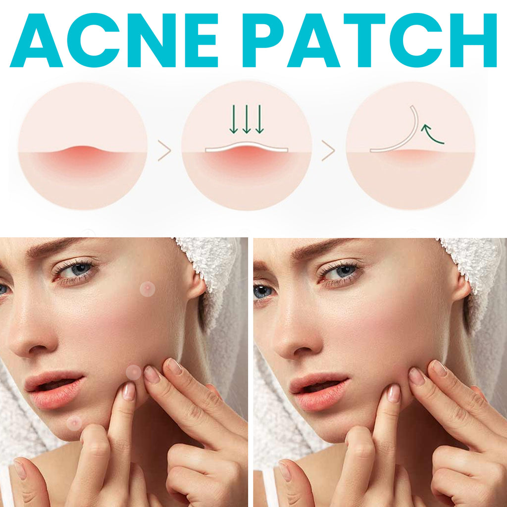 OUHOE Acne Patch, Repair Facial Acne Invisible Concealer Hydrocolloid Patch
