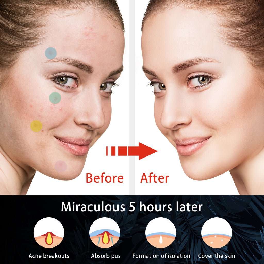 Hydrocolloid Acne Patch, Mild Non-Irritant Lightening Acne Pimples Closed Mouth Improve Acne Muscle Hydrocolloidal Acne Patch