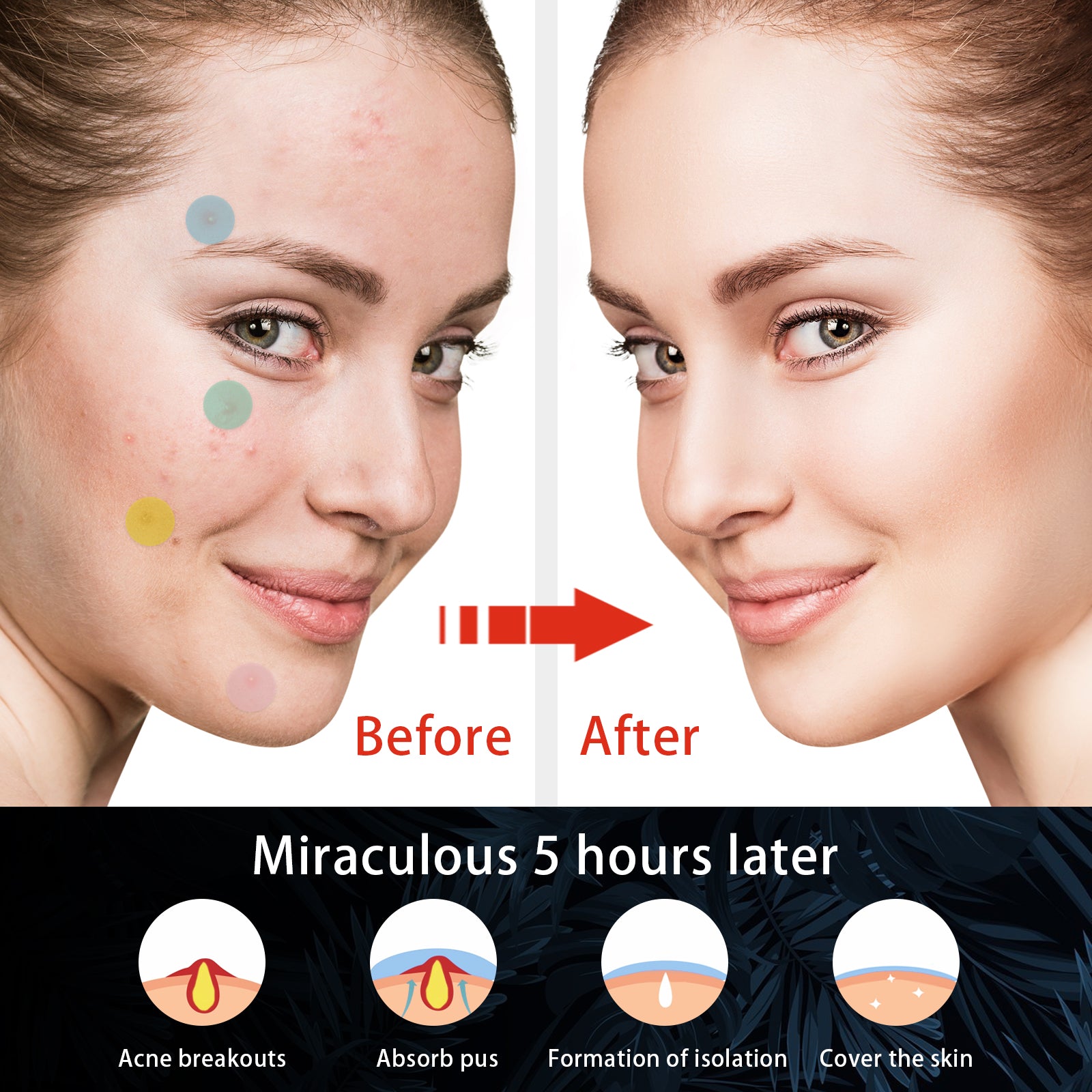 Hydrocolloid Acne Patch, Mild Non-Irritant Lightening Acne Pimples Closed Mouth Improve Acne Muscle Hydrocolloidal Acne Patch